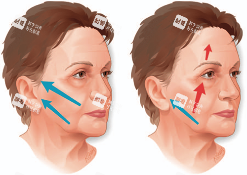 面部提升年輕化圖片