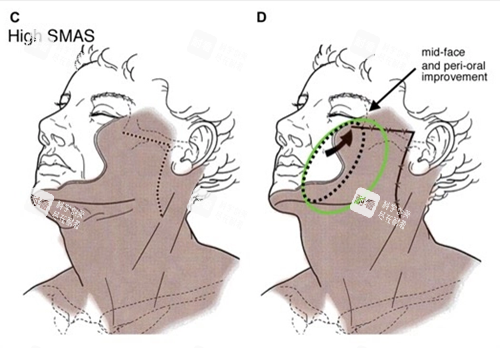 面部提升圖示一覽