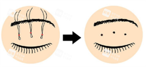 皮下速接雙眼皮操作過程圖解