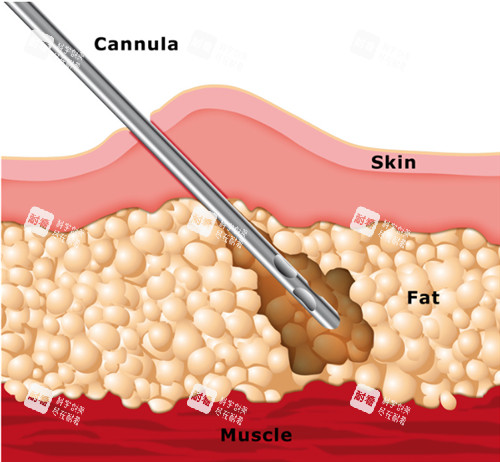 吸脂手術(shù)動(dòng)畫(huà)演示