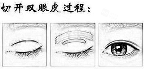 切開雙眼皮