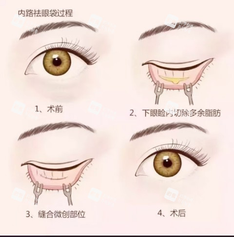 內(nèi)路祛眼袋
