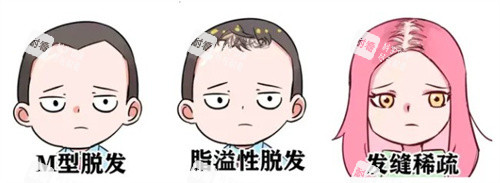 脫發(fā)種類