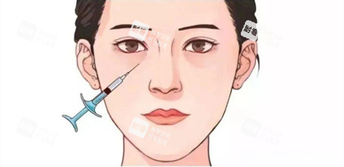 淚溝注射填充位置展示動畫圖