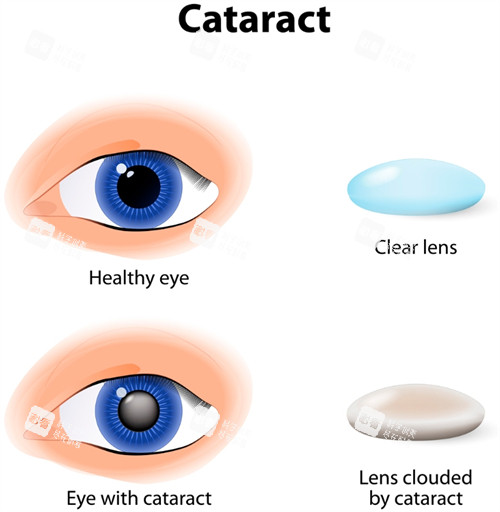 白內(nèi)障眼睛和正常眼睛區(qū)別