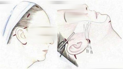 拉皮選劉文閣還是魏廣運？從排名、滿意度到價格，一篇說清誰更值