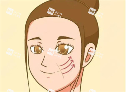 拉皮手術(shù)圖片