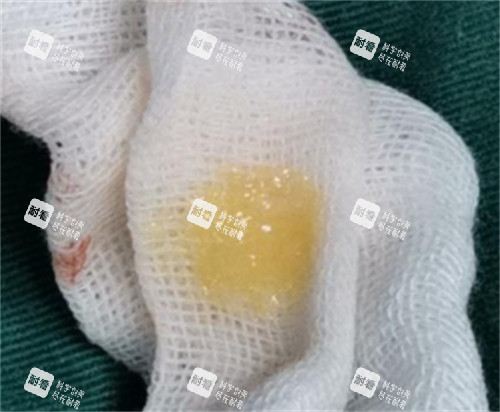 生長(zhǎng)因子剛剛注射后取出的樣子