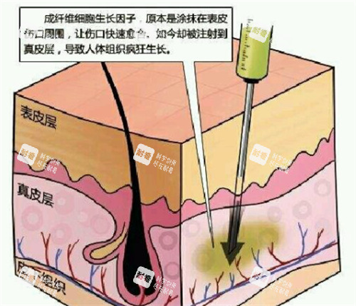 生長(zhǎng)因子的副作用解析