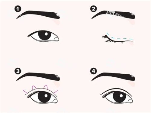 埋線雙眼皮手術過程圖 埋線雙眼皮手術過程圖