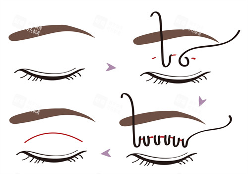 埋線雙眼皮手術過程 埋線雙眼皮手術過程