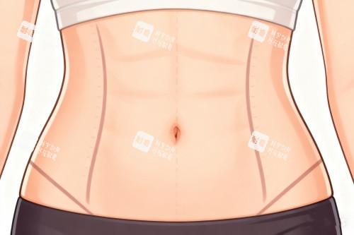 腹壁成型術成果一覽