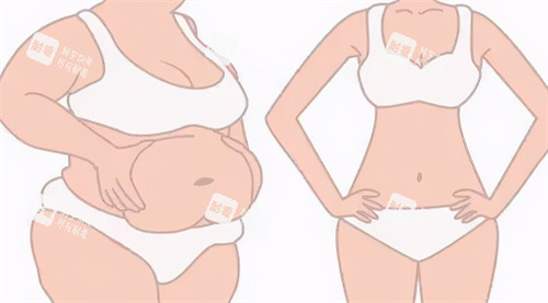 腹部吸脂前后對比過程