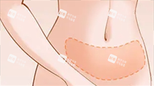 腹部吸脂成效展示圖