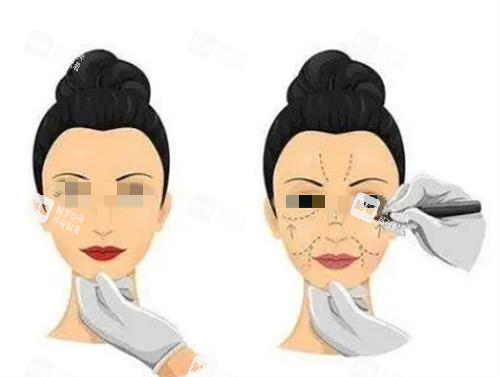 拉皮手術術前畫線圖