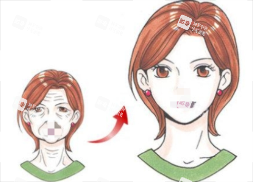 拉皮手術前后對比圖