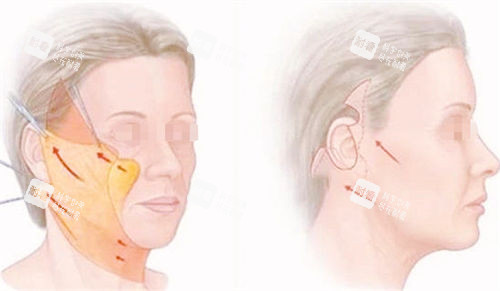 拉皮手術前后成果對比展示圖