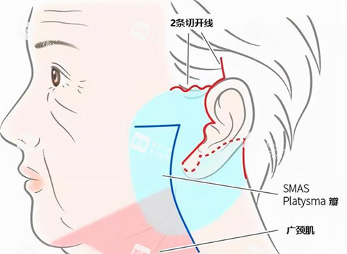 面部拉皮手術(shù)