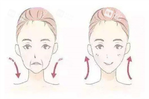 拉皮面部提升對比卡通示意圖