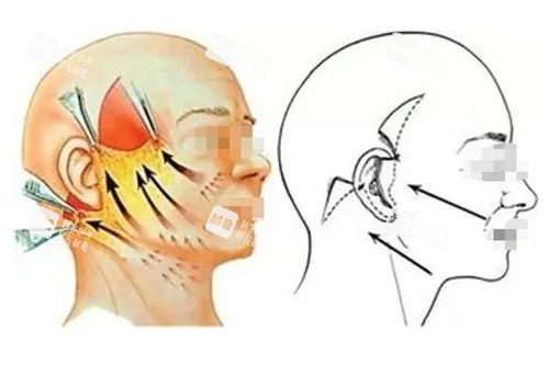 拉皮手術(shù)前后提拉對比圖