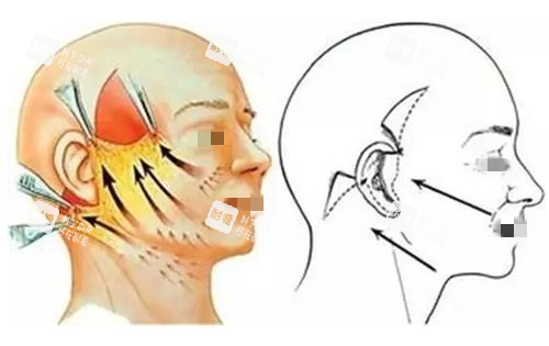 拉皮手術(shù)縫合前后示意圖