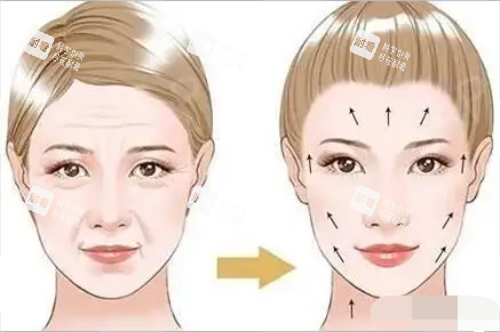 拉皮對(duì)比圖