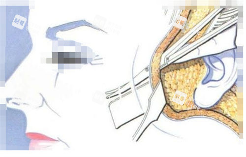拉皮手術(shù)手術(shù)剖面圖