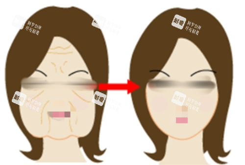 拉皮前后明顯對(duì)比圖