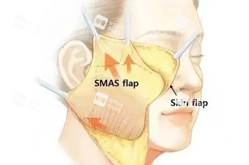 面部拉皮卡通示意圖