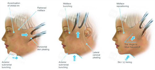 拉皮手術(shù)不同角度