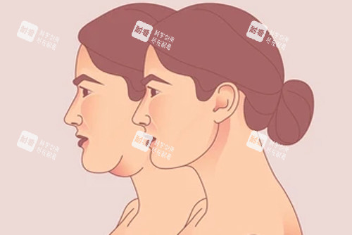 頸部拉皮變成天鵝頸 頸部拉皮變成天鵝頸