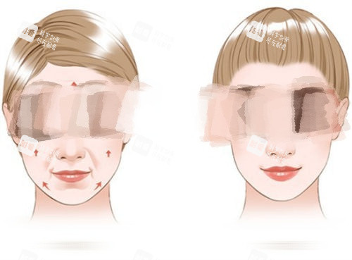 拉皮手術(shù)提拉方向示意圖.jpg 拉皮手術(shù)提拉方向示意圖.jpg