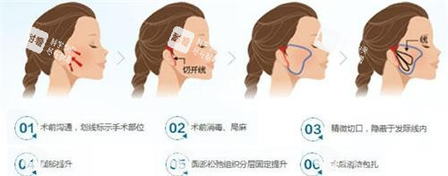 微拉美拉皮手術(shù)過程圖 微拉美拉皮手術(shù)過程圖