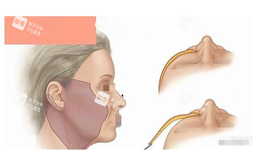 拉皮手術(shù)術(shù)中示意圖 拉皮手術(shù)術(shù)中示意圖