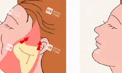 拉皮手術的術后對比圖