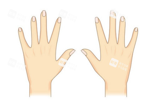 手背拉皮術后示意圖