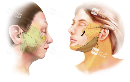 拉皮手術面部脂肪組織區(qū)域圈畫圖