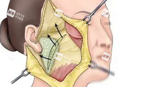 拉皮手術剖開動畫示意圖