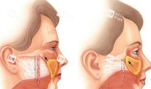 拉皮手術(shù)前后對比