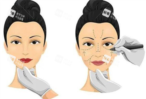 小拉皮手術(shù)過程