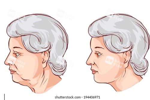 頸部拉皮卡通圖