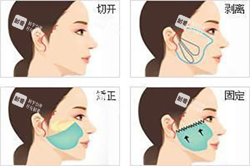 面部耳際小切口拉皮示意圖
