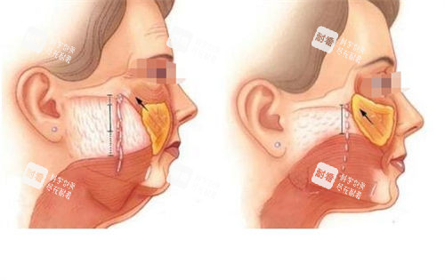 拉皮手術(shù)皮下組織切面對比展示圖