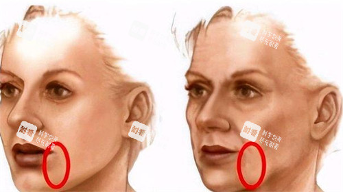 口角囊袋展示圖