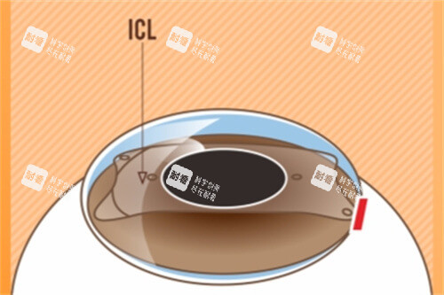 ICL晶體植入后示意圖