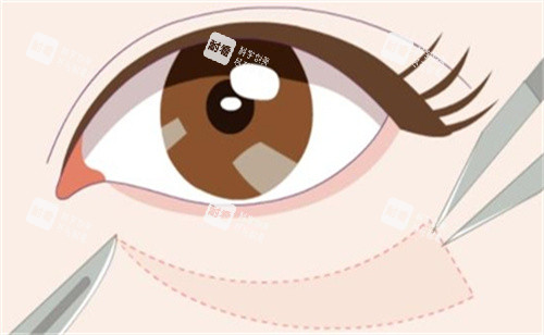 祛眼袋手術(shù)