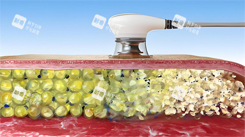 超聲波溶脂過(guò)程演示圖