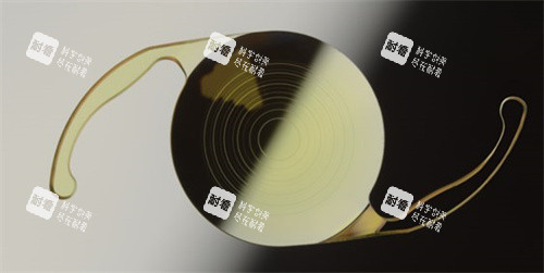 植入ICL晶體 植入ICL晶體