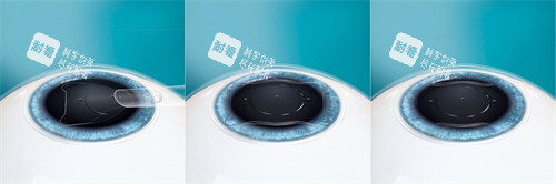 ICL晶體植入過程 ICL晶體植入過程