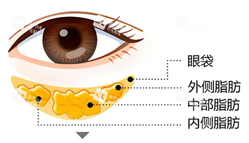 眼袋問題形成因